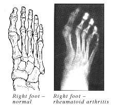 Rheumatoid Arthritis