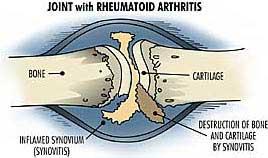 Joint Rheumatoid Arthritis