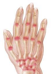 Inflamed Arthritis