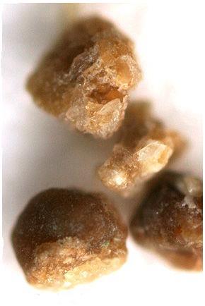 Kidney Stones